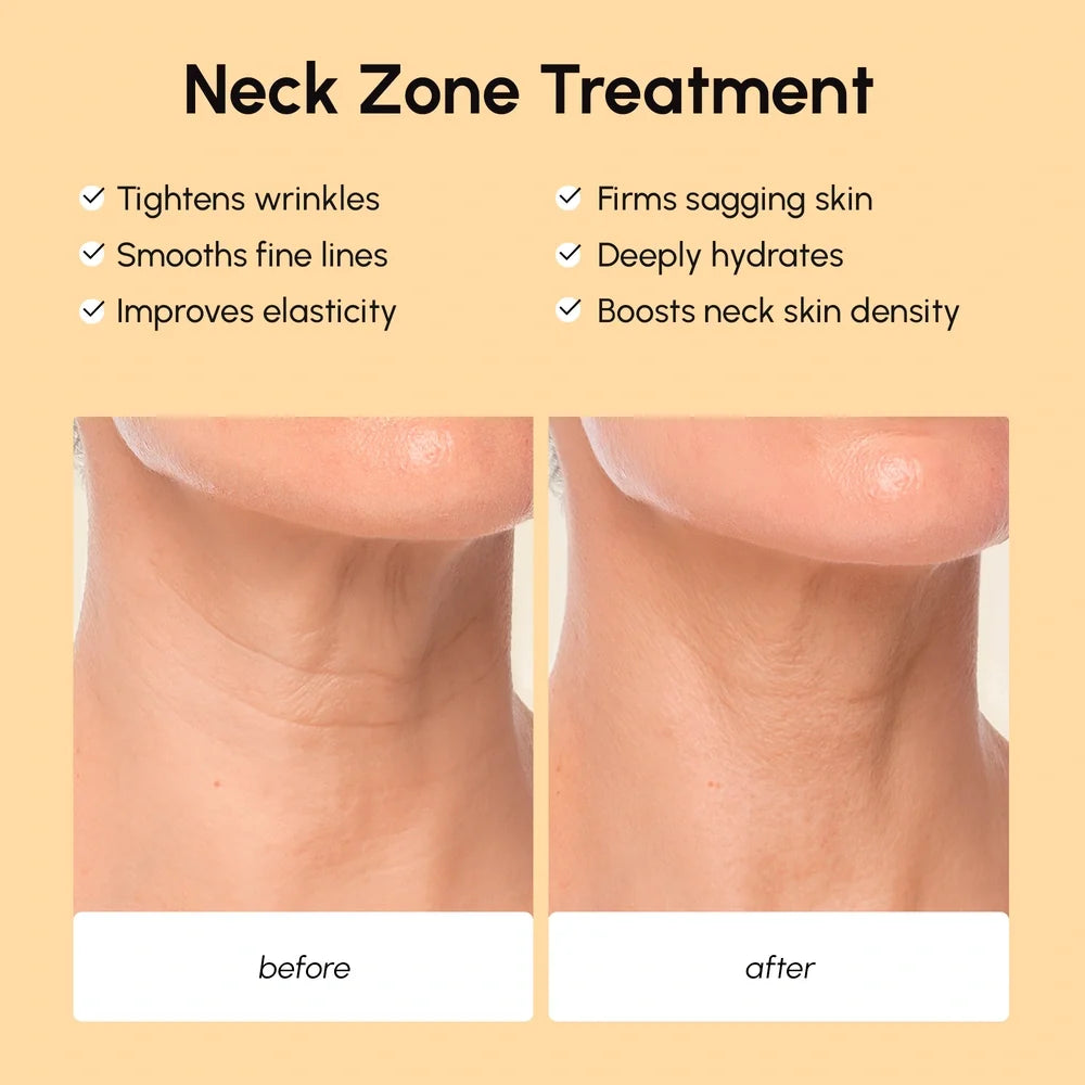 Lifting Neck Wrinkle with Maree Patches