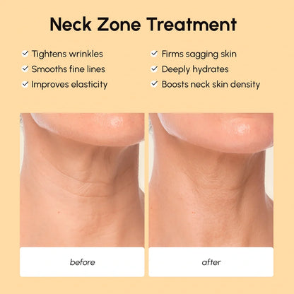 Lifting Neck Wrinkle with Maree Patches